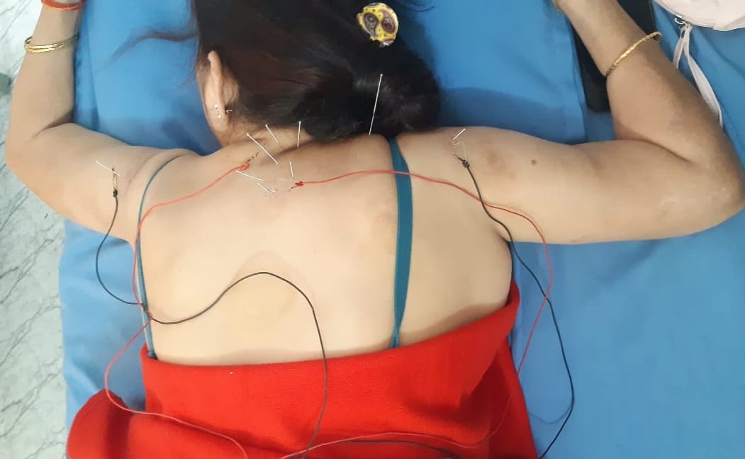 Electro Acupuncture 